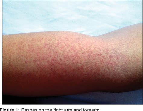 abilify rash